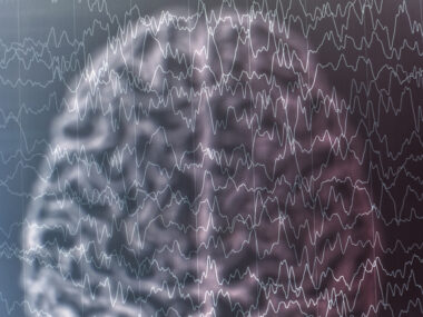 brain activity, Angelman